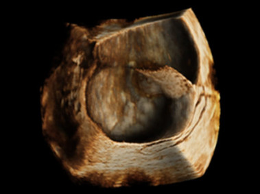 Clinical Image - MyLab<sup>™</sup>Alpha - Volumetric Imaging