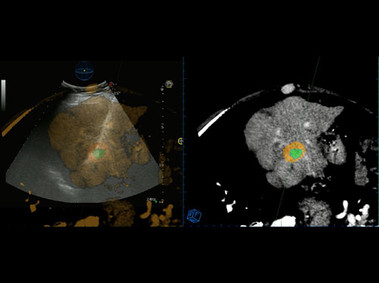 Clinical Image - MyLab<sup>™</sup>Eight Platform - Virtually-guided Liver Thermal Ablation with Necrosis Area Prediction