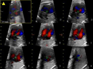 Clinical Image - MyLab<sup>™</sup>Eight Platform - 3D Imaging - Cardio (Stick)