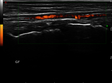 Clinical Image - MyLab<sup>™</sup>Twice - Right Foot - PWR