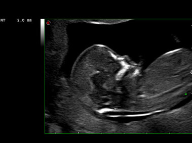 Clinical Image - MyLab<sup>™</sup>Seven - High Frequency Imaging