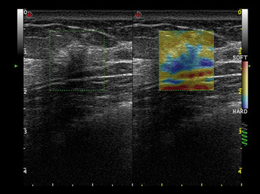 Clinical Image - MyLab<sup>™</sup>Alpha - Breast (Elaxto Imaging)