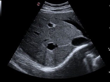 Clinical Image - MyLab<sup>™</sup>Omega - CPI and XView+ liver cyst visualization