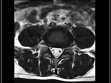 G-scan Brio - LSpine - 3D HYCE Axial
