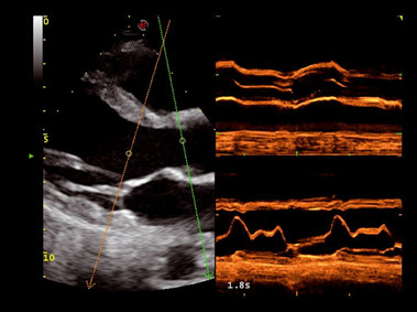 Clinical Image - MyLab<sup>™</sup>Seven - LV Compass M-Mode (CMM Imaging)