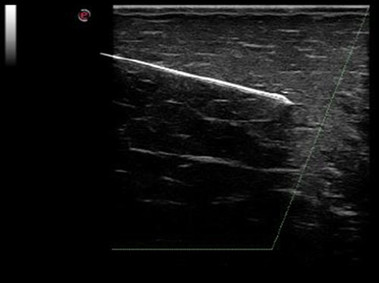 Clinical Image - MyLab<sup>™</sup>Seven - Needle Enhancement