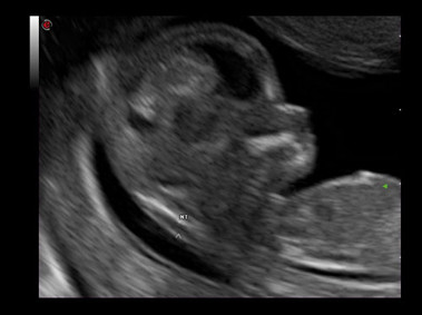 Clinical Image - MyLab<sup>™</sup>Alpha - Fetus (XView - MView - TEI<sup>™</sup>Imaging)