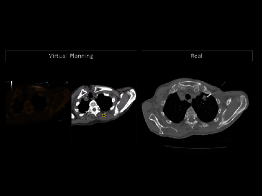 Clinical Image - MyLab<sup>™</sup>Eight eXP - Virtual Planning vs Needle Placement in Lung