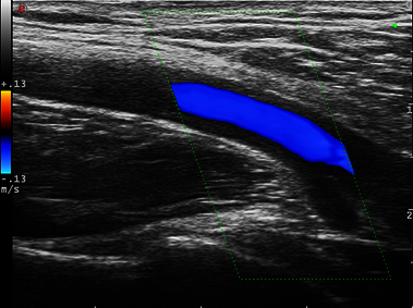 Clinical Image - MyLab<sup>™</sup>Twice - Axillary arteritis - CFM