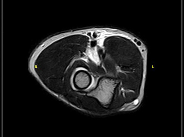 O-scan - Elbow - FSE T2 Axial