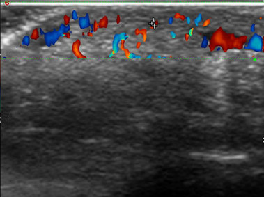 Clinical Image - MyLab<sup>™</sup>Twice - Finger (CFM Imaging)
