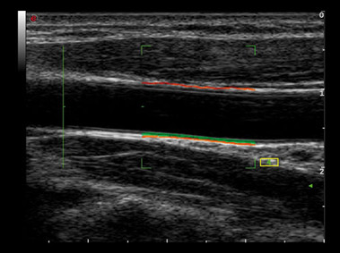 Clinical Image - MyLab<sup>™</sup>Alpha - Carotid Artery (RFQIMT Imaging)