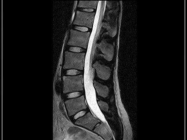G-scan Brio - LSpine - FSE T2 Sagittal