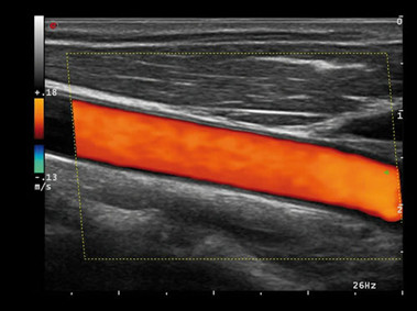 Image clinique - MyLab<sup>™</sup>Alpha - Artère carotide (Imagerie HD CFM)