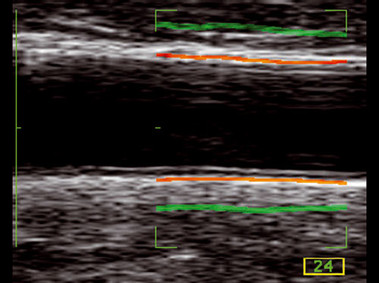 Clinical Image - MyLab<sup>™</sup>Twice - Carotid Artery