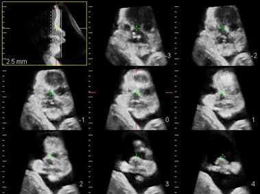 Clinical Image - MyLab<sup>™</sup>Seven - Baby Face (X4D Imaging)