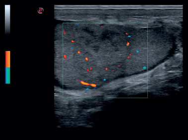 Immagine clinica - MyLab<sup>™</sup>Six - Testicolo (Imaging B+CFM)