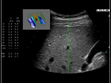 Clinical Image - MyLab<sup>™</sup>9 Platform - Q-ElaXto point Shearwave Elastography in liver
