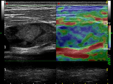 Clinical Image - MyLab<sup>™</sup>Seven - Strain-based Elastography