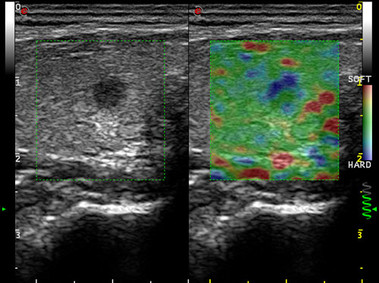 Clinical Image - MyLab<sup>™</sup>Twice - Strain Elastography