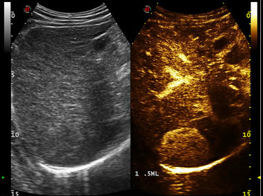 Clinical Image - MyLab<sup>™</sup>Eight Platform - Dual Contrast Enhanced Ultrasound