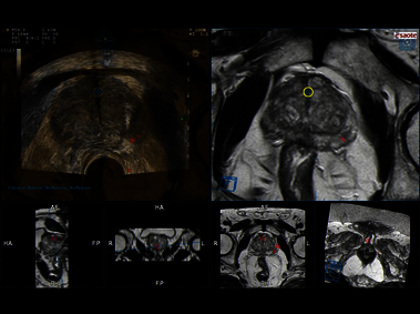 Clinical Image - MyLab<sup>™</sup>Eight eXP - Single target prostate biopsy
