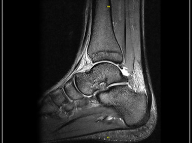 G-scan Brio - Ankle - GE T2 Sagittal