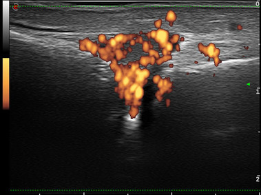 Clinical Image - MyLab<sup>™</sup>Seven - XFlow Color Imaging