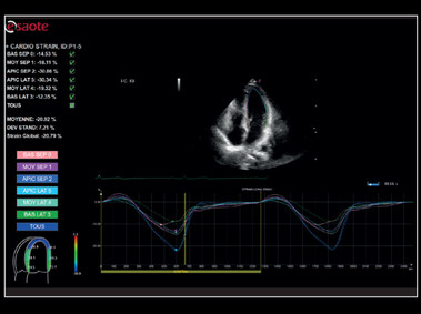 Clinical Image - MyLab<sup>™</sup>X8 Platform - Cardiac - Zero-click strain evaluation with XStrain<sup>™</sup>2D