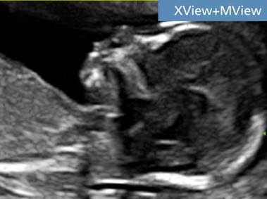 Clinical Image - MyLab<sup>™</sup>Seven - XView & MView Imaging