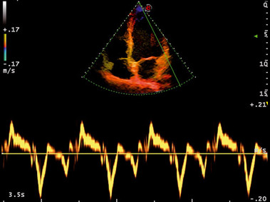 Clinical Image - MyLab<sup>™</sup>Seven - Heart Tissue Doppler Imaging (TVM Imaging)