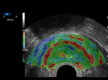 Clinical Image - MyLab<sup>™</sup>Eight Platform - Endo and Transrectal Strain Elastography