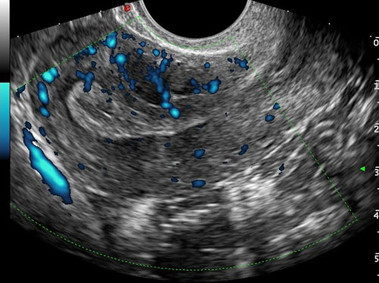 Clinical Image - MyLab<sup>™</sup>Twice - 3D Imaging - Gynaecology - (PWD)