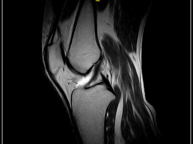 G-scan Brio - Knee - FSE T2 Sagittal