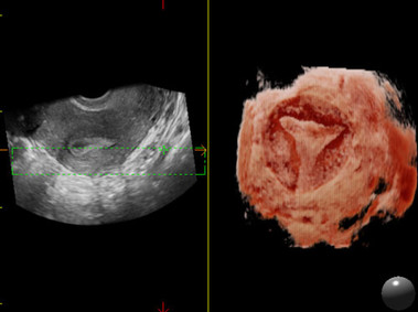 Clinical Image - MyLab<sup>™</sup>Eight Platform - 3D Imaging - Gynaecology (XLight)