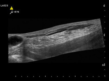 Clinical Image - MyLab<sup>™</sup>Alpha - Broken Baker Cyst (VPan Imaging)