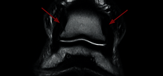 Clinical Image - O-scan equine: Lesion of the collateral ligaments of the coffin joint