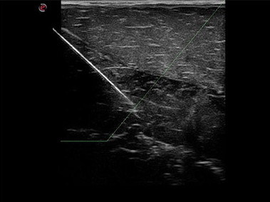 Clinical Image - MyLab<sup>™</sup>Alpha - Needle enhancement