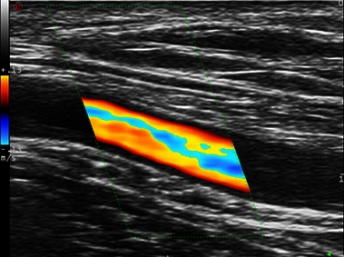 Clinical Image - MyLab<sup>™</sup>Twice - Axillary arteritis - CFM