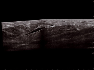 Clinical Image - MyLab<sup>™</sup>Twice - Muscle (VPan Imaging)