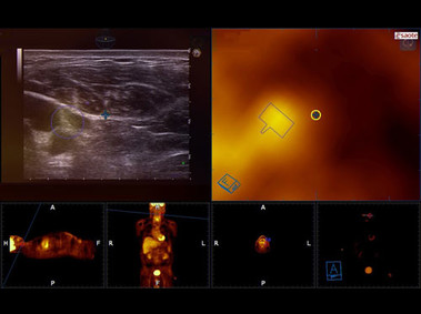 Clinical Image - MyLab<sup>™</sup>Eight Platform - PET-guided Neck FNA