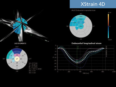Clinical Image - MyLab<sup>™</sup>Seven - XStrain4D Imaging