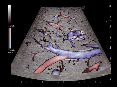 Clinical Image - MyLab<sup>™</sup>Seven - Intraoperative (DIR XFlow Imaging)