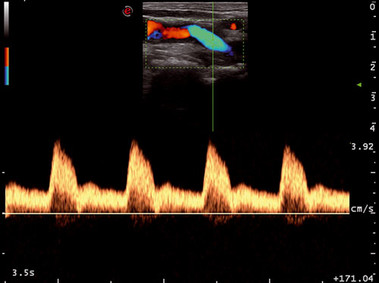 Clinical Image - MyLab<sup>™</sup>Seven - Carotid Artery (PW Doppler Tracing)