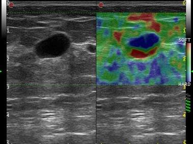 Clinical Image - MyLab<sup>™</sup>Omega - Dual ElaXto on breast cyst