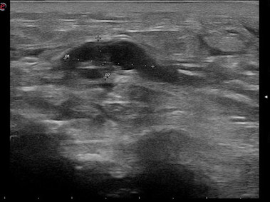 Clinical Image - MyLab<sup>™</sup>Alpha - Wrist Cyst