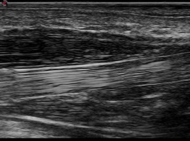 Clinical Image - MyLab<sup>™</sup>Seven - Flexor - Tendon
