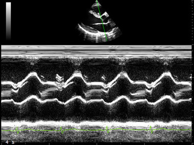 Clinical Image - MyLab<sup>™</sup>Eight Platform - Heart (M-Mode)