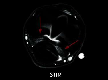Clinical Image - O-scan equine: Fetlock Arthropathy