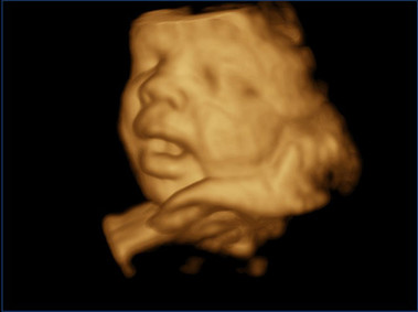 Clinical Image - MyLab<sup>™</sup>Twice - Baby Face (X4D Imaging)
